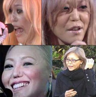 keiko 整形