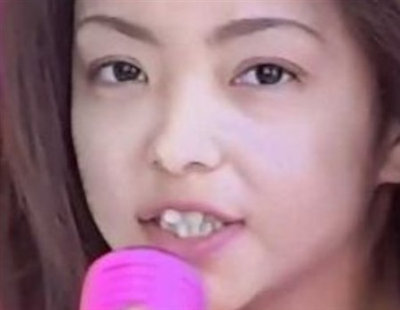 安室奈美恵 整形