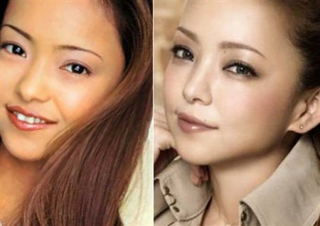 安室奈美恵 整形