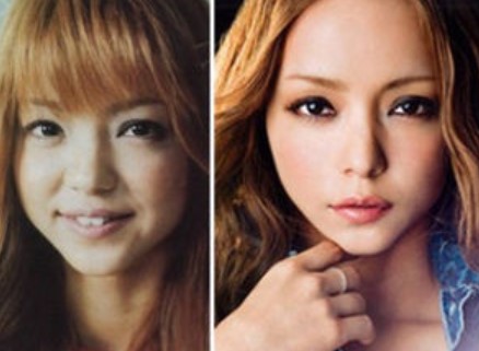 安室奈美恵 整形