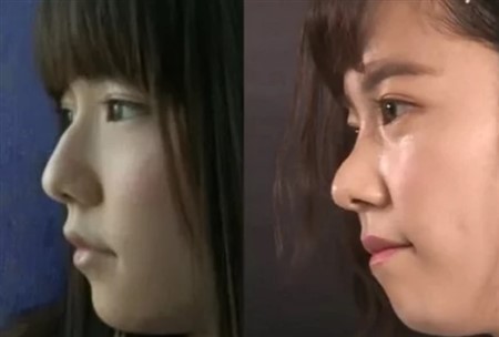 島崎遥香 整形 劣化